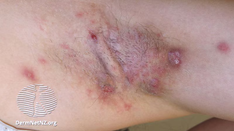 'Early HS can mimic an intense folliculitis or furuncles that can sometimes be caused by Staphylococcus infections,' Sayed said. ms.spr.ly/6012YXV5y