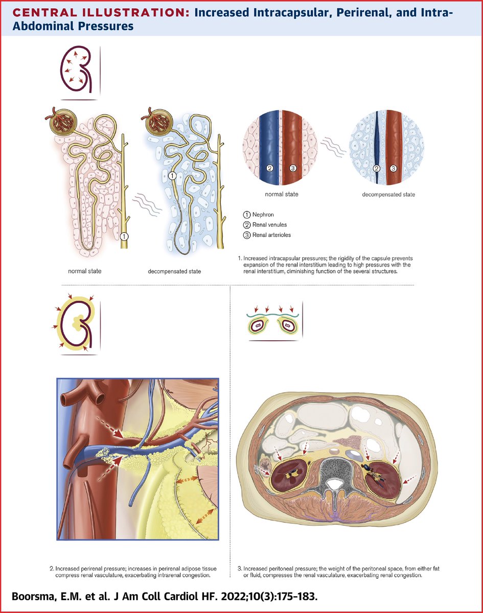 Renal Compression in #HeartFailure: The Renal Tamponade Hypothesis 🔗 jacc.org/doi/10.1016/j.… #FOAMed #FOAMcc #POCUS #Nephpearls