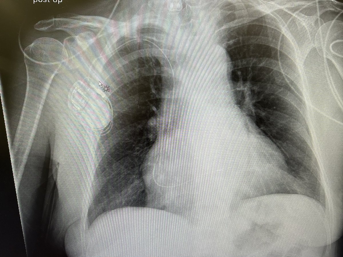 Do you think this is left septal or non selective LBBAP? From the right due to persistent SVC