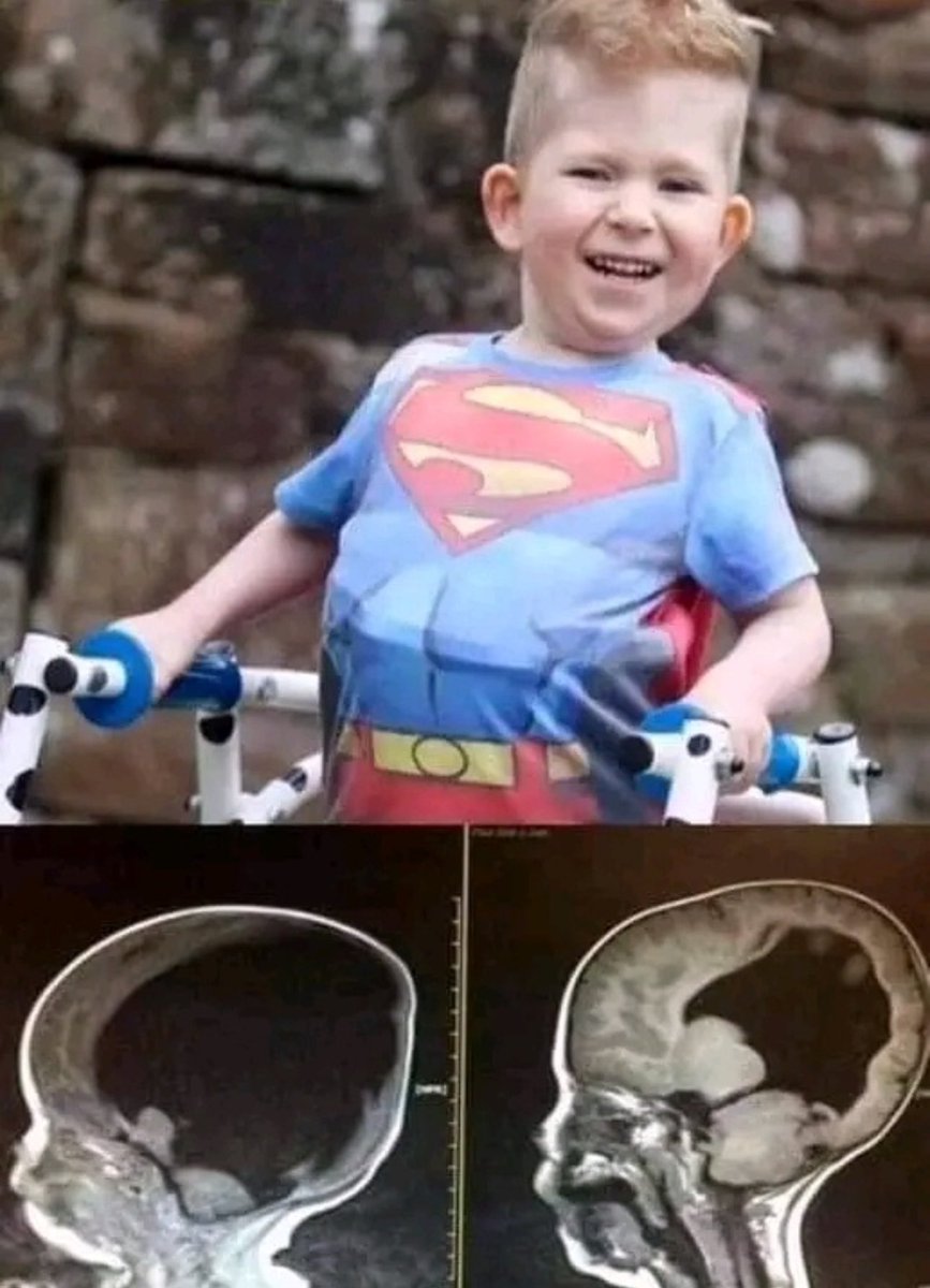 THE BOY WHO WAS BORN WITHOUT A BRAIN This little guy is called Noah, and is practically a 'walking miracle,' since before his birth his parents were informed that his son was going to have a severe brain disability, which would not allow him, not even, to move. Noah was born