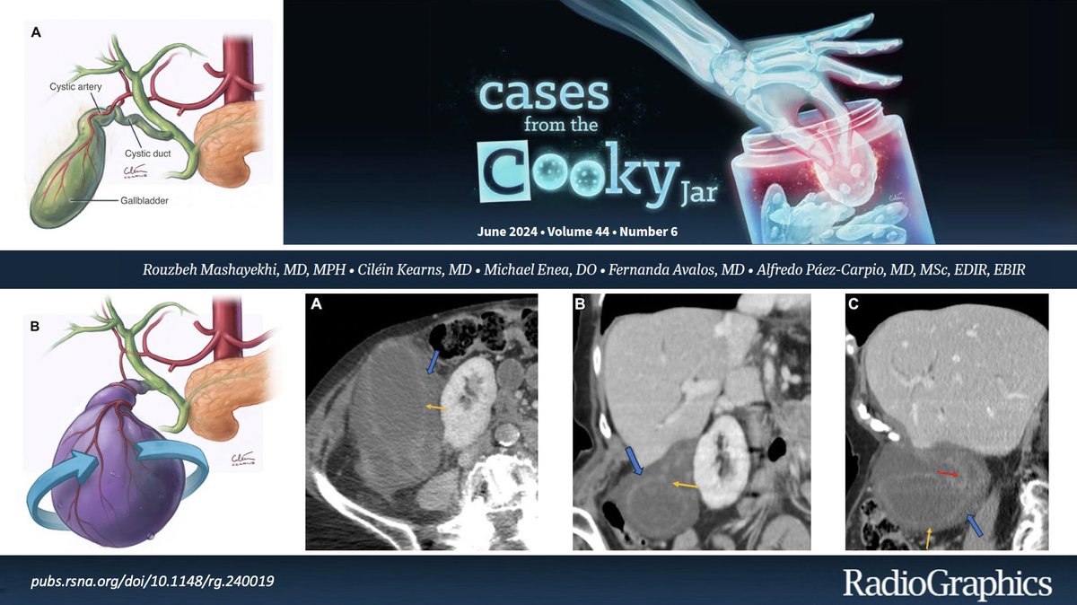 Cases From the Cooky Jar (@casescookyjar) on Twitter photo 84-year-old woman with vomiting and severe abdominal pain. Diagnosis❓
Answer: 🔗pubs.rsna.org/doi/10.1148/rg…
Have a companion case? Share using #CookyBites #163 and we will RT the best cases! <a href="/cookyscan1/">Cooky Menias</a> <a href="/RadioGraphics/">RadioGraphics</a> #RGphx 84-year-old woman with vomiting and severe abdominal pain. Diagnosis❓
Answer: 🔗pubs.rsna.org/doi/10.1148/rg…
Have a companion case? Share using #CookyBites #163 and we will RT the best cases! <a href="/cookyscan1/">Cooky Menias</a> <a href="/RadioGraphics/">RadioGraphics</a> #RGphx
