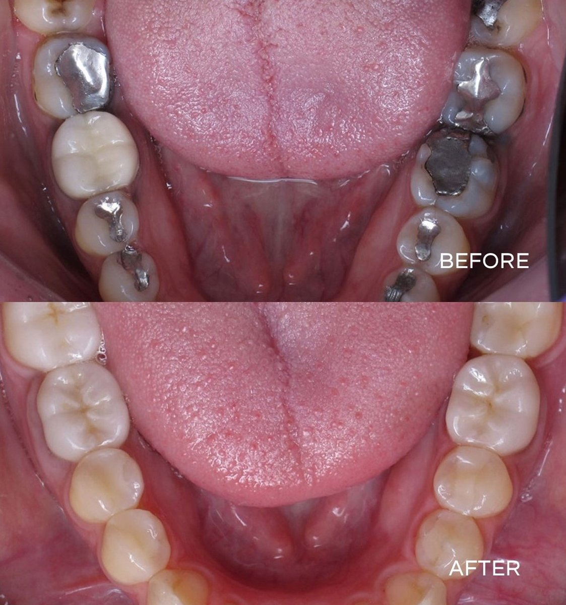 The before photo is of a patient who wanted to replace their amalgam fillings. The after photo was achieved with the installation of coloured composite dental fillings.

#flossdental #thetoothdr #flossboss #beforeandafter #fillings #repost #andersondentistry #trinidadandtobago