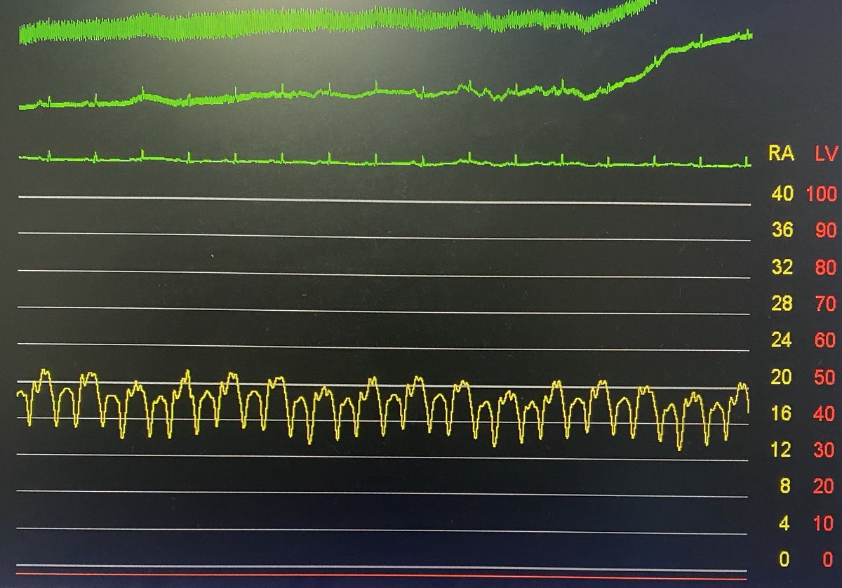 Cath quiz for fellows. Finding/diagnosis from this RA tracing?