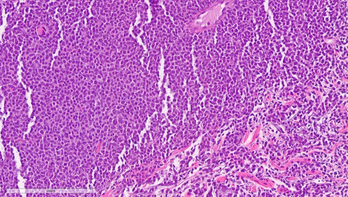 Skin involvement with Blastic Plasmacytoid Dendritic Cell Neoplasm (BPDCN)

Infiltrates of immature neoplastic cells with blastoid morphology.

Involves superficial and deep dermis, often with extension into subcutis.

Epidermis typically spared.