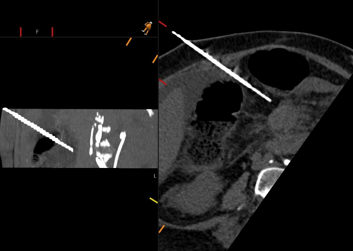 Enhancing mass occluding the SMV with secondary venous ischemia. Tricky biopsy at an oblique angle between bowel loops Pathology = low grade neuroendocrine neoplasm (carcinoid) #meded #radiology #abdrad #abdomen #imaging