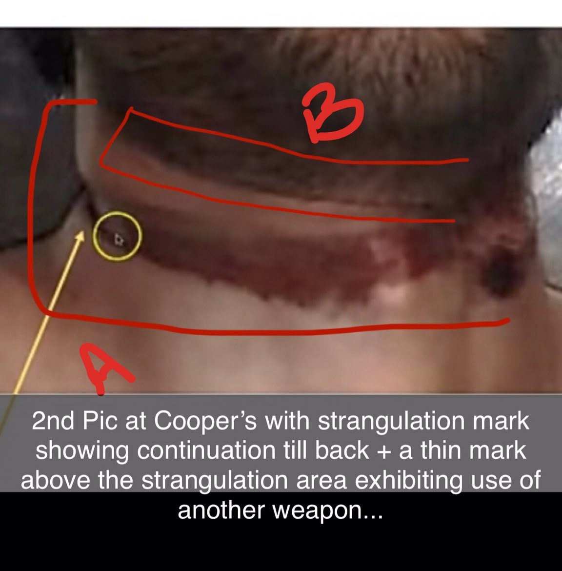 📌A deep 'O' shaped mark on Sushant's neck is an indicator of strangulation, not hanging! Is this mere fact not sufficient for investigation under 302❓ @CBIHeadquarters @arjunrammeghwal @IPS_Association @PMOIndia CBI SSR Ko Insaaf Do #JusticeForSushantSinghRajput