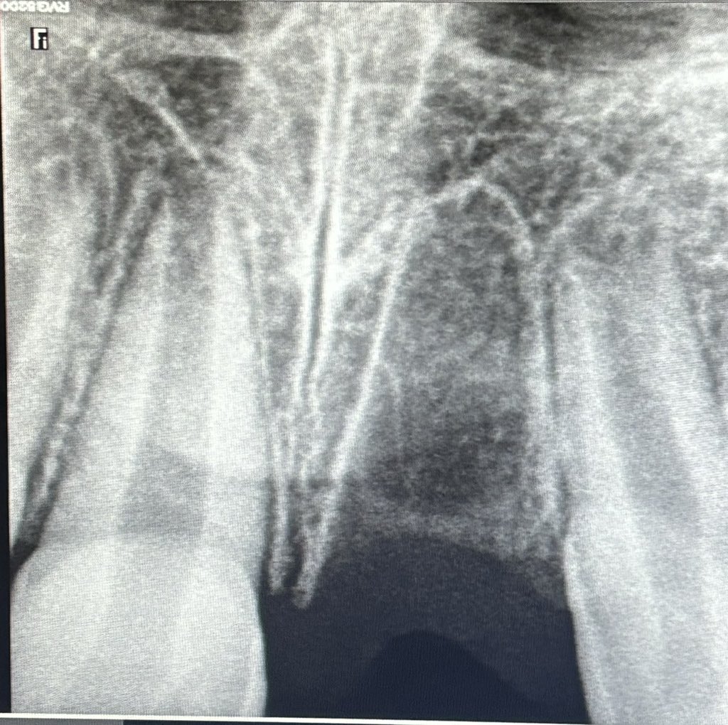 ATTENTION PARENTS OF YOUNG PARENTS: if your child knocks off a permanent tooth in toto, please rush to your/nearest dentist asap! A tooth that comes out in one piece can be RE IMPLANTED and stays for decades! Saw a 10 year old today who has lost his permanent central