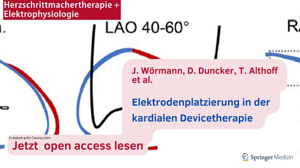 Praxisorientierte Schritt-für-Schritt-Anleitung zur richtigen #Elektrodenplatzierung ▶️Jetzt open access lesen in der Zeitschrift #HerzschrittmachertherapieundElektrophysiologie 👉go.sn.pub/uj3hz4 @AGEP_DGK @DavidDuncker @Phiso_de @ChristianHeeger @YoungDgk @ViclouiseJ