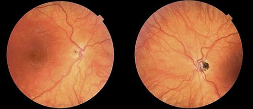 Stress-Induced Oculogyric Crisis in Septo-Optic Dysplasia: Case Report 

➡️ ow.ly/ww5650Ruqt5
✍️ Keys P. et al. 
📖 #CaseRepOphthalmol 

#OpenAccess