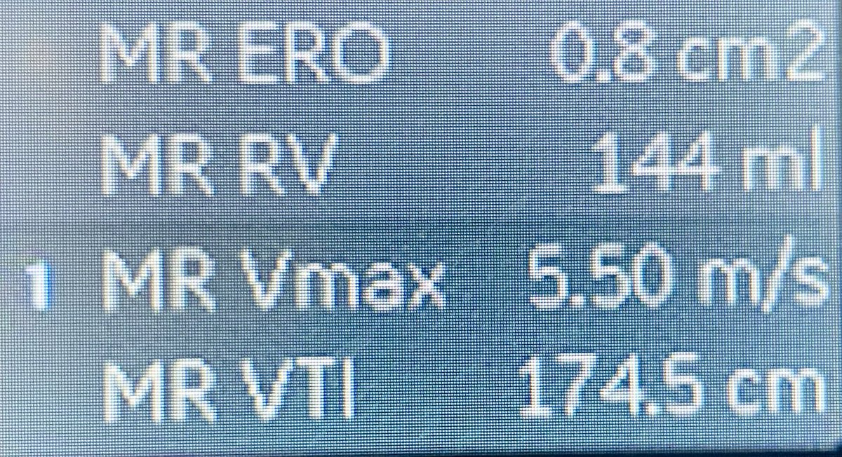 What do you think about this Reg. Volume in primary MR? LV EF is reported to be 60% #echofirst #EchoMath