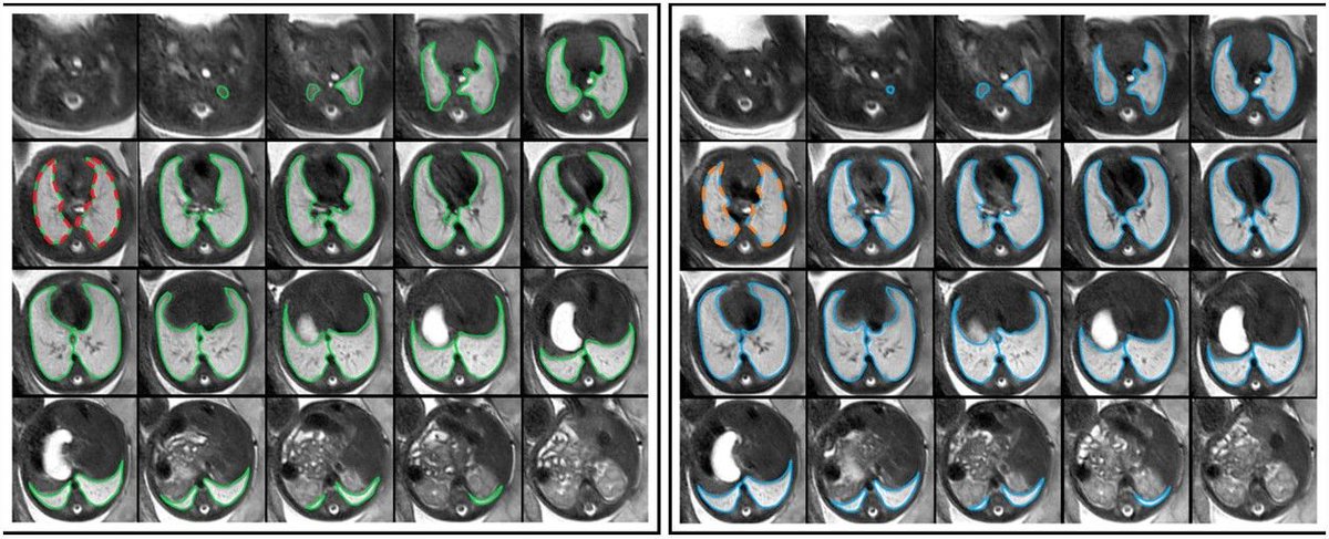 When comparing the reproducibility of 2D vs 3D #radiomics, Martin L. Watzenboeck et al. discovered that fetal #MRI radiomics features extracted from 3D whole lung segmentation masks showed significantly higher reproducibility.

#InsightsIntoImaging

🔗 buff.ly/4a5btp2
