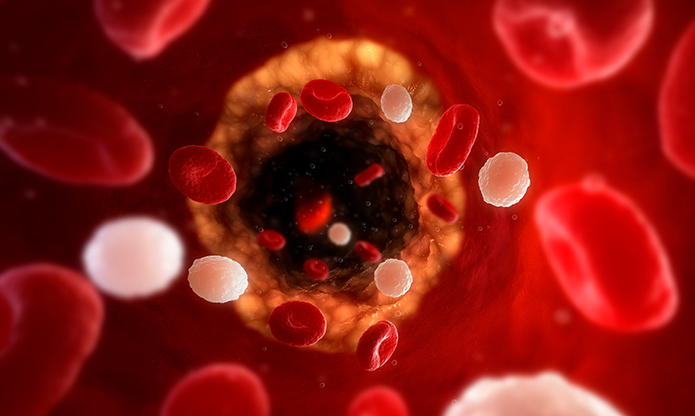Globally, cardiovascular diseases due to atherosclerosis – the build-up of plaque in arteries – are the leading cause of death. A new Danish-Spanish project aims to develop methods to detect atherosclerosis at earlier ages and encourage prevention.

The initiative is led by