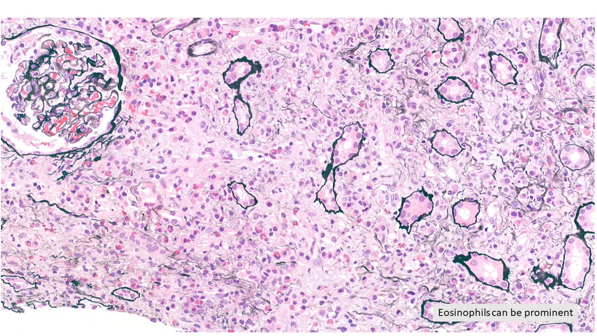 IgG4-related TIN in 50s M. Plasma cells show dominant Ig4 staining (not shown). #renalpath #pathX