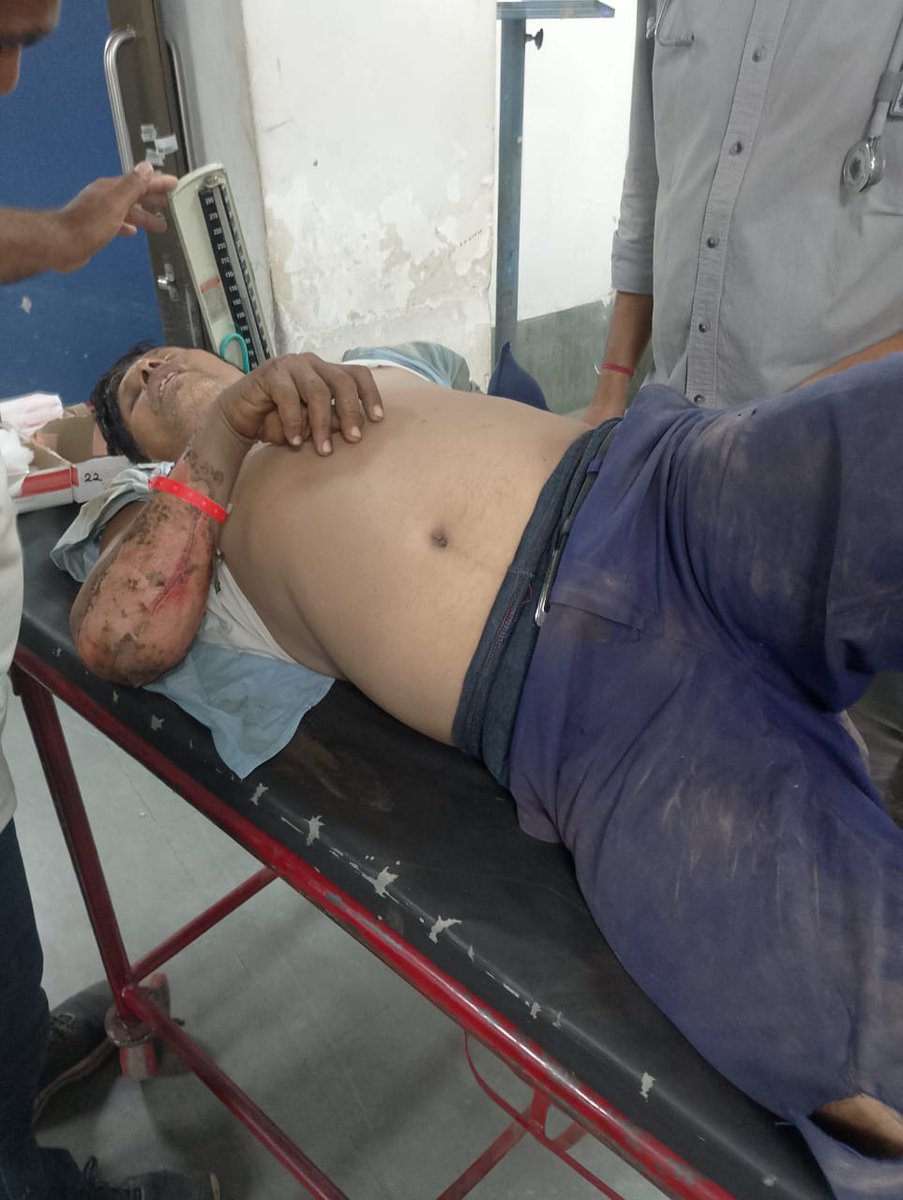 IRSTMU (@irstmu) on Twitter photo <a href="/narendramodi/">Narendra Modi</a> <a href="/PMOIndia/">PMO India</a> <a href="/AshwiniVaishnaw/">Ashwini Vaishnaw</a> <a href="/RailMinIndia/">Ministry of Railways</a> <a href="/IR_CRB/">RB CRB</a> <a href="/MIrailwaybd/">Member Infra Railway Board</a> <a href="/Gmwrly/">GMWR</a> <a href="/drmadiwr/">DRM Ahmedabad</a> प्रशासन की घोर लापरवाही अहमदाबाद मंडल में शाहिबाग केबिन में
दो सिग्नल कर्मचारी बूरी तरह OHE से जले
गंभीर हालत में ICU में भर्ती
S/12 shifting work बिना OHE block लिये कराया गया काम <a href="/narendramodi/">Narendra Modi</a> <a href="/PMOIndia/">PMO India</a> <a href="/AshwiniVaishnaw/">Ashwini Vaishnaw</a> <a href="/RailMinIndia/">Ministry of Railways</a> <a href="/IR_CRB/">RB CRB</a> <a href="/MIrailwaybd/">Member Infra Railway Board</a> <a href="/Gmwrly/">GMWR</a> <a href="/drmadiwr/">DRM Ahmedabad</a> प्रशासन की घोर लापरवाही अहमदाबाद मंडल में शाहिबाग केबिन में
दो सिग्नल कर्मचारी बूरी तरह OHE से जले
गंभीर हालत में ICU में भर्ती
S/12 shifting work बिना OHE block लिये कराया गया काम