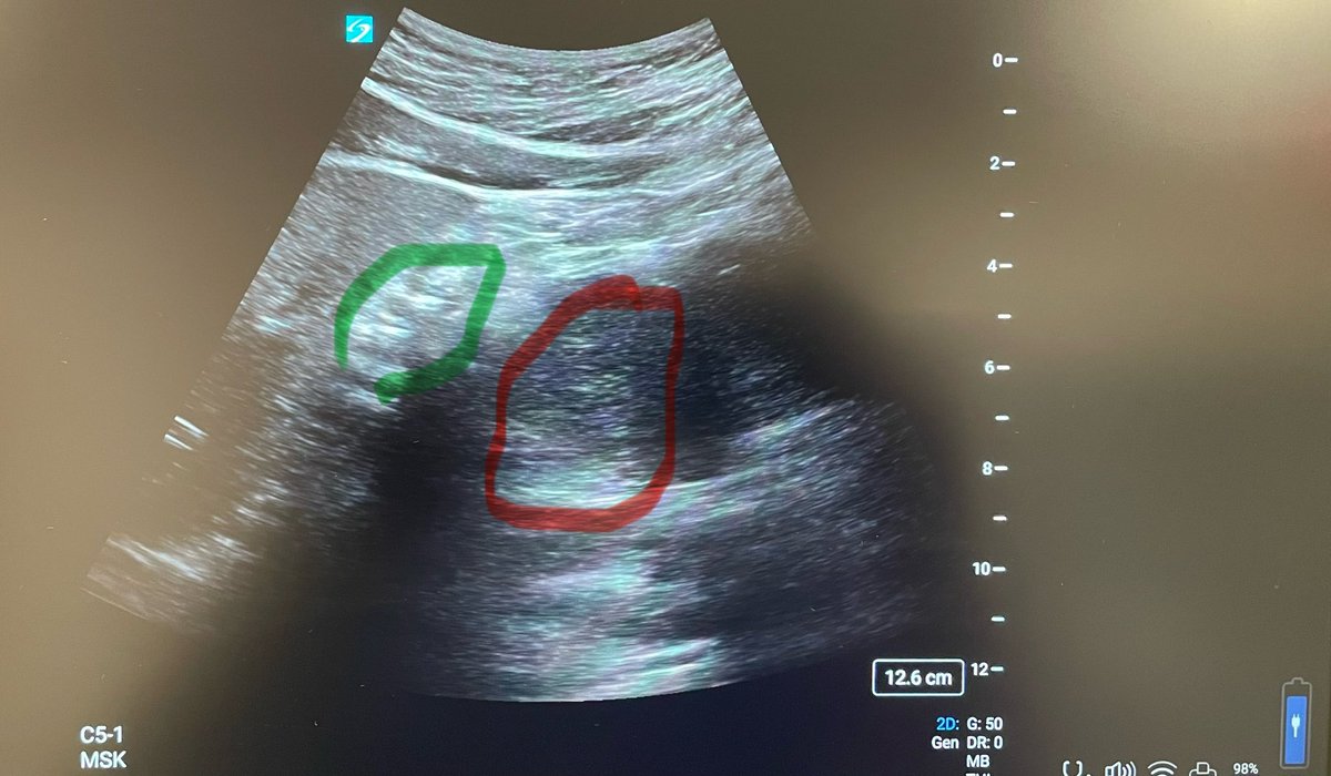 #POCUS

🟢🟢 Empty antrum !
🔴🔴 Dilated small bowel ‼️‼️

Based on the history… scan beyond #gastricultrasound for safe airway management!!

Join @ASRA_Society #ASRAPOCUS courses to learn !

asra.com/events-educati… @NarouzeMD @Ropivacaine @ASRAPM_Ex_Dir @SuryakumarNara1