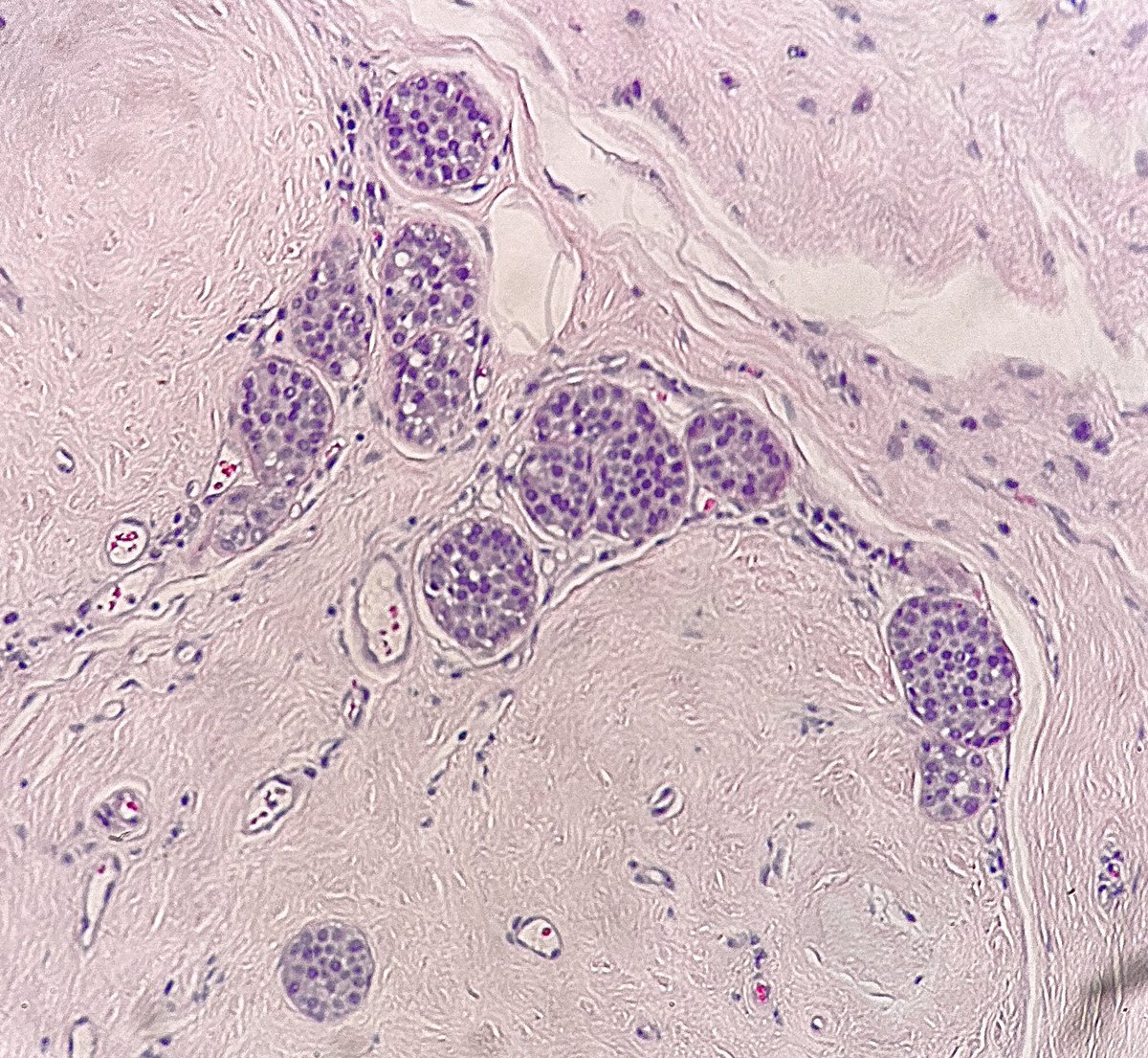 Fibroadenoma

• Fibroepithelial lesion with median age of 25 years old. 

• Benign but 1.5-2x increased relative risk of breast cancer 

• For fibroadenomas, rule out any involved atypia 

👇 LCIS involving Fibroadenoma

Image credit: Michelle Josey, MD
#pathagonia #pathx