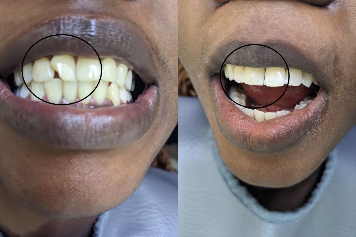 Happy client= Happy us #customerreview 
Check-Up K200.
Composite Filling K500 per tooth.
Locations: Lusaka, Kabwe, Ndola, Kitwe & Chipata
Call/WhatsApp: 0976942794 To Book An Appointment Today
Our Mission: A Perfect Smile Zambia