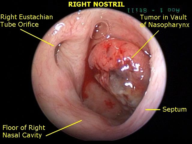 Carcinoma nasofaríngeo:

1) Otitis media recurrente
2) Epistaxis
3) Linfadenopatia cervical 

🗝️ Complicación grave de Mononucleosis Infecciosa
(virus de Epstein-Barr [herpes virus humano-4])

#VEB #mononucleosis #carcinoma #epsteinbarr #Xmed #MedX #MedEd #medtwitter #cancer #med