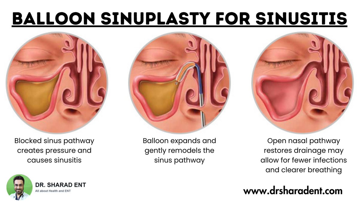 DrSharadEnt's tweet photo. Discover the life-changing benefits of Balloon Sinuplasty for chronic sinusitis!

Visit- https://t.co/WRh9BPU2V5

#BalloonSinuplasty #sinusitis #nose #ENT #blog https://t.co/SuHjtz6a8E