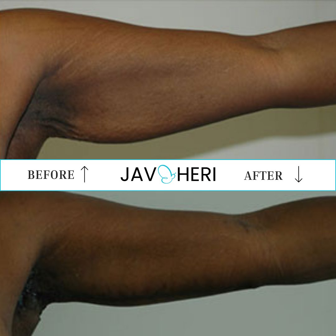 Shahin Javaheri, MD - Plastic Surgeon tweet media