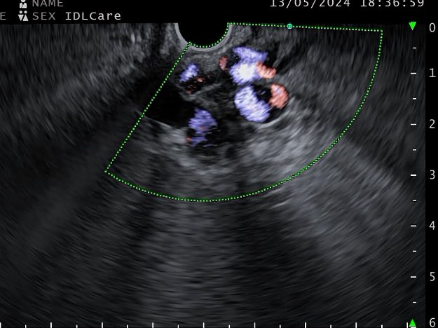 Large gastric varix. We again tried injecting 0.5 cc glue in the feeder. 80% obliteration. Needed another 0.5 cc. Avoided the coils altogether #GITwitter