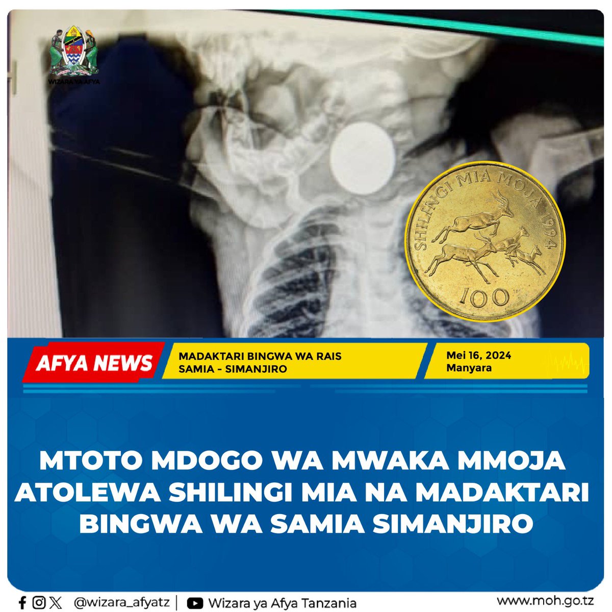 Na WAF, SIMANJIRO MANYARA Madakatari Bingwa na Bobezi walioweka kambi katika Hospitali ya Wilaya ya Simanjiro mkoani Manyara wamefanikiwa kumtolea shilingi mia mtoto Abdallah mwenye umri wa mwaka mmoja. Daktari Bingwa wa Usingizi na Ganzi Benedicto Mwampashi kutoka Muhimbili,