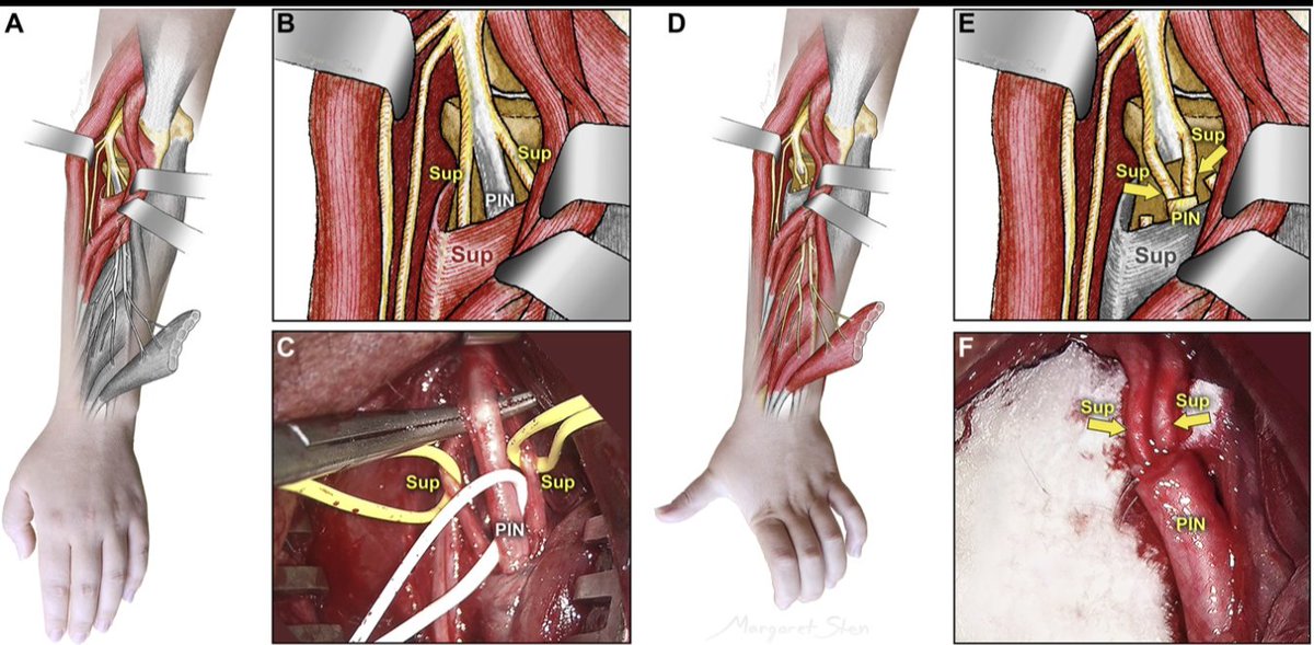 #NEUNew From this month's cover: Supinator to Posterior Interosseous Nerve Transfer for Recovery of Hand Opening in the Tetraplegic Patient: A Case Series bit.ly/4bkCVAE by Bazarek et al @BWHNeurosurgery @JasNsgy @CNS_Update @DKondziolkaCNS @AliAlawiehmdphd @Zaazoue