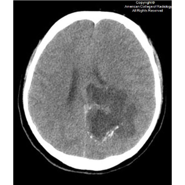 A 26-year-old man presents with a 2-week history of worsening headaches, nausea and vomiting. #ACRCaseinPoint bit.ly/3Wh1kSW