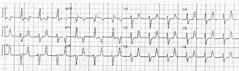 60 year old brought by EMS wth lethargy and nausea. What do you think? 
#ECG #EKG #MedTwitter #meded #foamed #MedstudentTwitter #CardioTwitter #paramedic #nurse #EmergencyMedicine