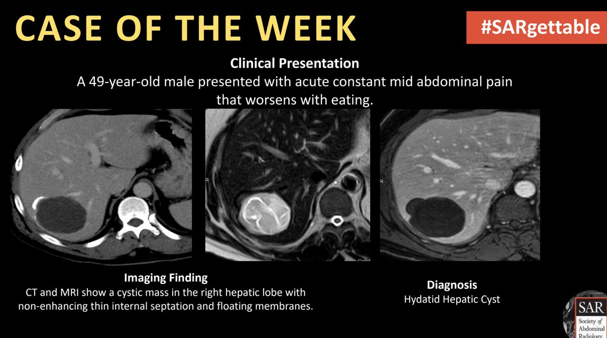 The answer to last week's #SARgettable Case of the Week, contributed by Dr. Lucy Muinov and Will Roeder, is: Hydatid Hepatic Cyst. Thanks for playing!