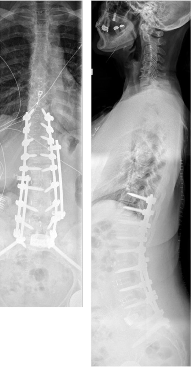 Staging deformity surgery can be helpful Stage 1:L5-S1 ALIF w/hyperlordotic cage Stage 2:t10-pelvis fusion with L12 PCO Original PI-LL mismatch = 30,now 11. One year later-zero back pain,able to partake in activities,including standing for more than 2 hours to paint @DukeSpine