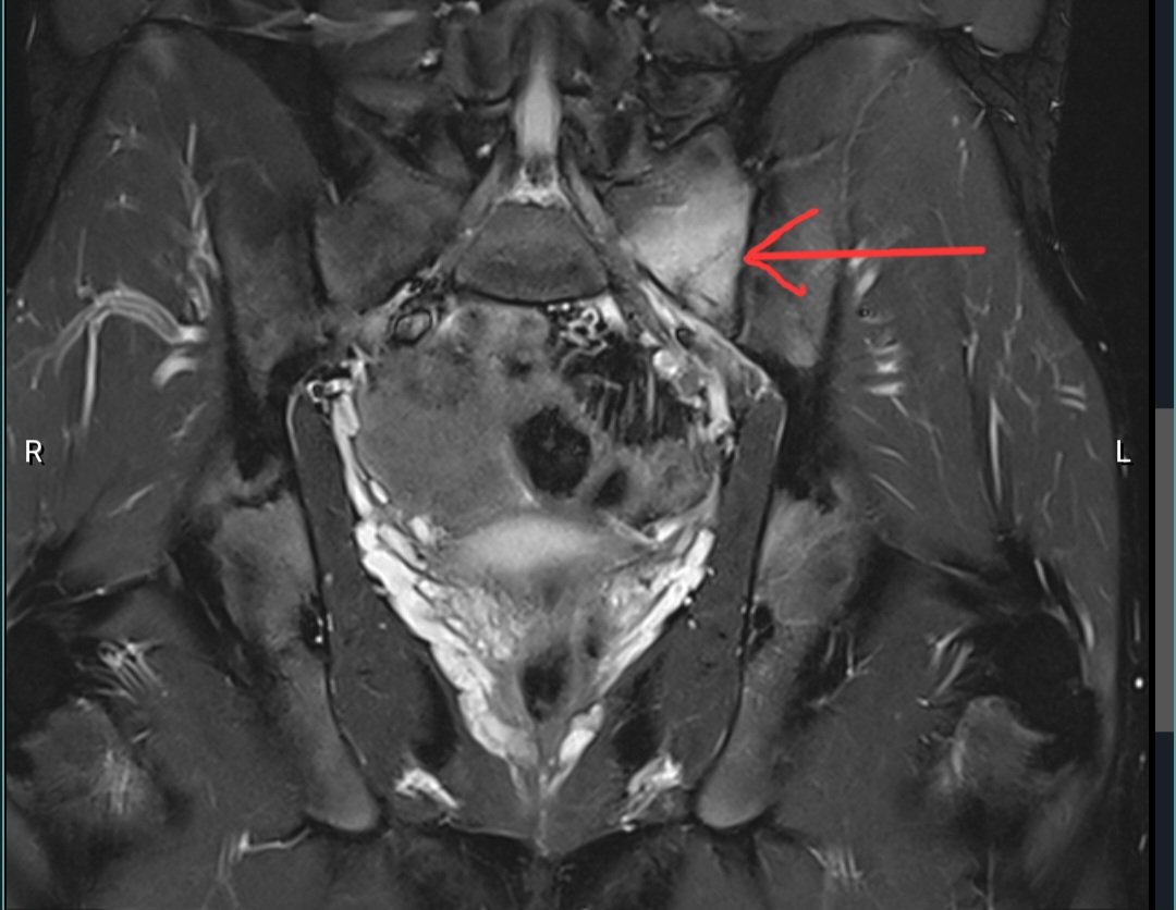Follow-up MRI Sacral stress fracture @DrJN_SportsMed