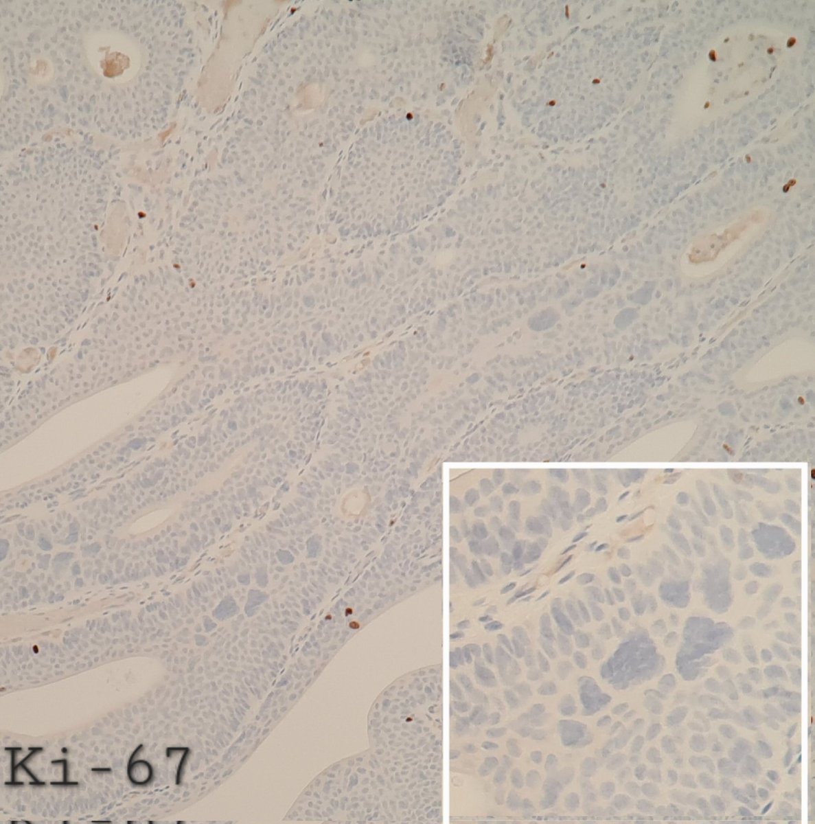 M, 79Y, bladder neck papillary tumour 2cm. Inverted papilloma with degenerative atypia. Key is low ki67 index with the large atypical nuclei negative for Ki67. #GUpathology #GUPATH #GU_path