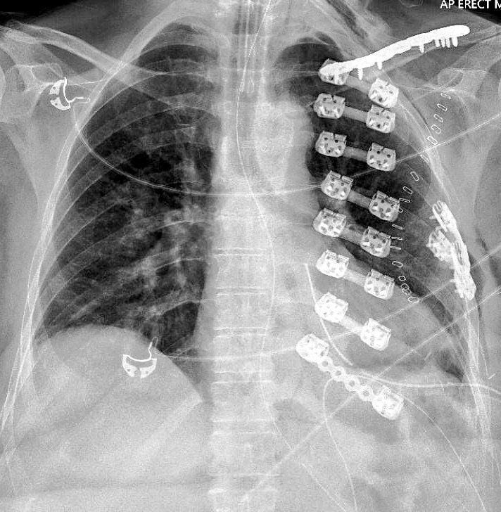 What are the findings?
A Patient admitted after motor Vehicle accident.
#MedTwitter #MedX #MedEd