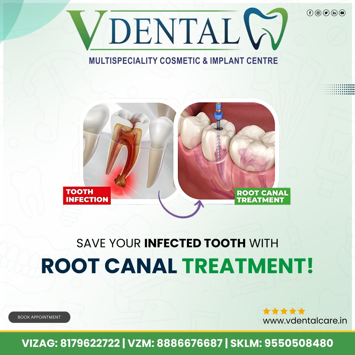 🦷 TOOTH INFECTION? 🦷

🔧 ROOT CANAL TREATMENT 🔧

✨ SAVE YOUR INFECTED TOOTH WITH ROOT CANAL TREATMENT!✨

📅 BOOK YOUR APPOINTMENT NOW!

🌐 Visit: vdentalcare.in
📍 Locations & Contact Numbers:

VIZAG: 8179622722
VZM: 8886676687
SKLM: 9550508480

#RootCanalTreatment