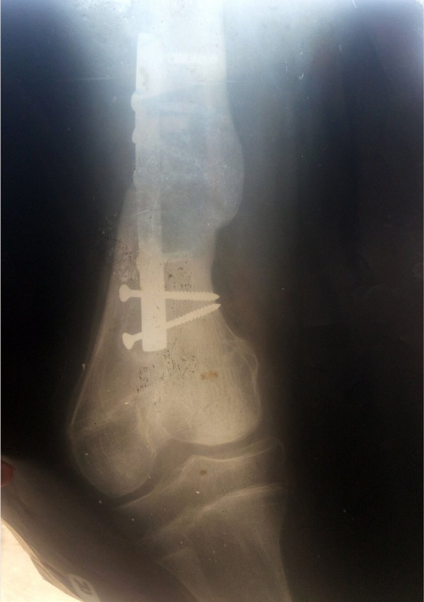 CodeWrack's tweet photo. Dear @davido & all great family here,
Sir/Ma, please help🙏
I'm groaning in dire body pains that may paralyse me or compel the amputation of my leg soon😭
I had iron objects buried in my broken leg in an operation to secure my bones & stabilise injuries
1/6
#HelpRotimi https://t.co/h2CnqiTewW