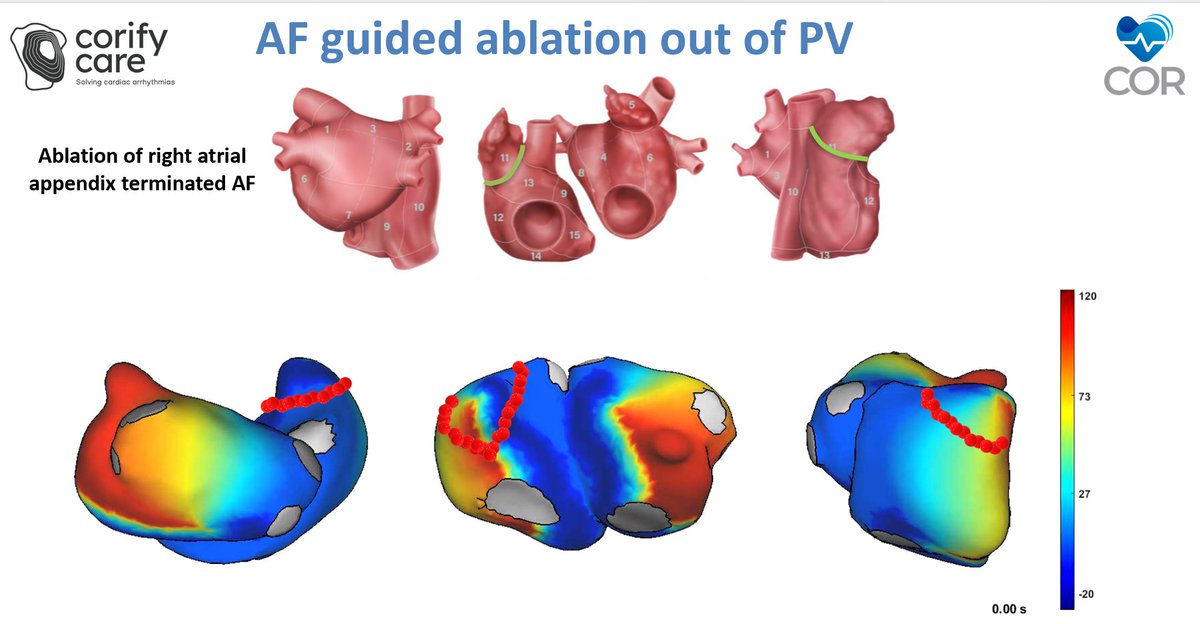 Friday at 10.30h @MariaSGuillem 's talk on 'AF Ablation Guided By Wavefront Mapping, AI, and Modelling' will cover innovative approaches combining AI with cardiac ablation techniques. A crucial topic for improving AF treatment. #HRS2024 #Ablation #AIinCardiology