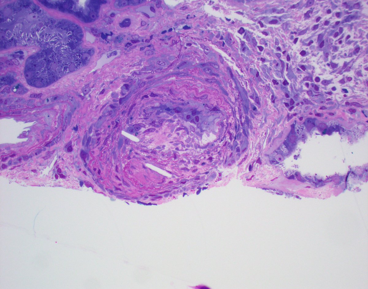 Older pt with recent worsening of renal function. Biopsy reveals cholesterol clefts in vessels consistent with atheroembolic disease. For whatever reason these lesions always seem to segregate into the IF and EM tissues. #Renalpath #nephrology #pathtwitter