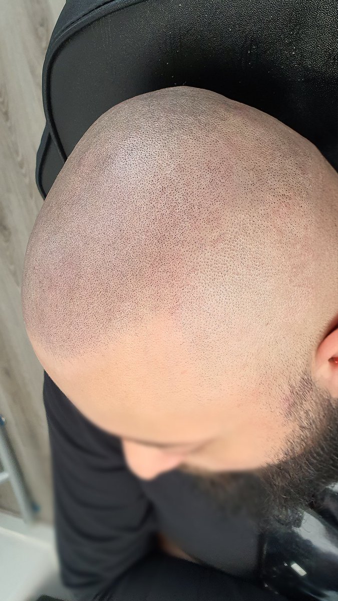 SkalpWorldwide's tweet image. Norwood 6 straight after 3rd session 🙌

Want to stop worrying about your hairline or don’t any hair left? we can give you any hairline you want and cover any bald areas.

Get in touch today!

#skalp #scalpmicropigmentation #SMP #hairtattoo #scalptattoo #hairlinetattoo