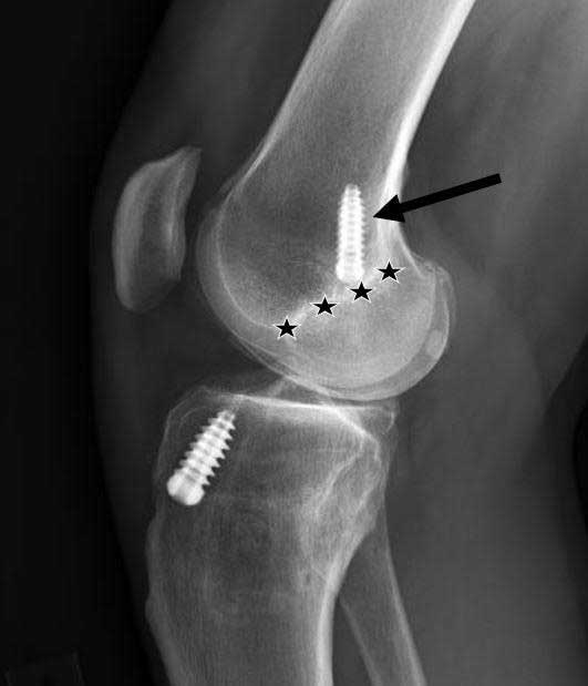 Wondering about ACL reconstruction after 60? Age isn't the only factor. Learn how activity levels, medical issues, and stability play a role. medilink.us/7wva #Orthopedics #ACLRecovery