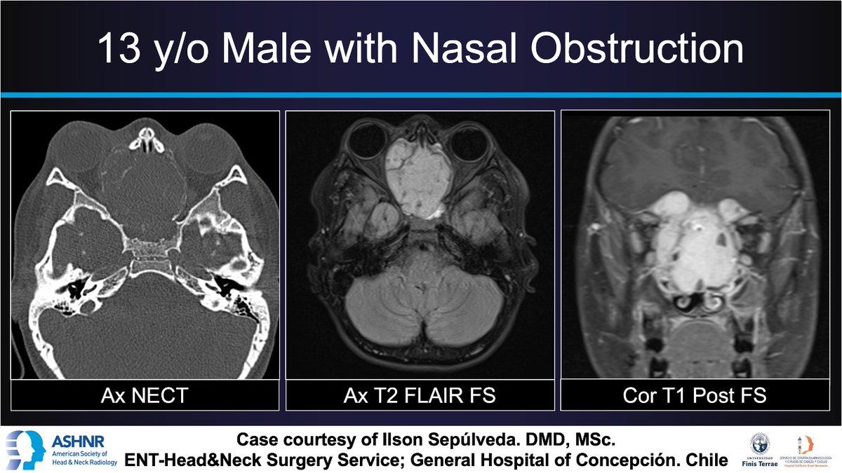 #ASHNRCOTW #253: Nasal obstruction. Thx @iasepulveda 4 case! #ASHNR24 Answer w/ appropriate GIF only -- stay professional & don't spoil it! @callyrobs @DShatzkes @CDP_Rad @rhwiggins @nakoontz @KRileyMD @CMGlastonbury @cmtomblinson @tabby_kennedy @PhilipRChapman1