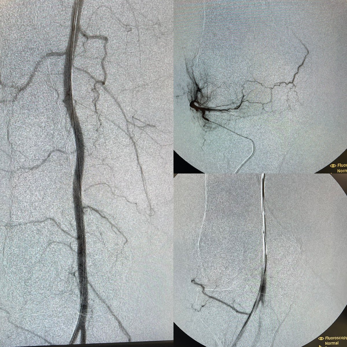 The AT anatomy plays a large role in rarer origins during #GAE. finding of ILGA from the AT in #GAE @IRcenters @AriIsaacsonMD @RPiechowiakDO @NoLimitIR @IR_SchwartzMD @marcus8j @DonGarbettMD @StreamMeeting Learn More at this years #PGYSTREAM September 2024