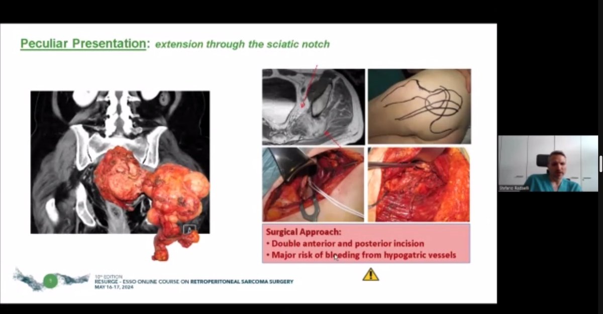 Grupo Mexicano de Sarcomas (@sarcoma_mx) on Twitter photo Thanks <a href="/ESSOnews/">European Society of Surgical Oncology (ESSO)</a> for the invitation to #RESURGE
International 🗺️ and regional 📍#sarcoma working group collab is 🔑 for evidence-based practice changes:
▪️Sarcoma reference programs
▪️Histology based tx
▪️Role of ☢️/💊
▪️Prehab & ERAS
Looking forward to live surgery tomorrow! 🎥 Thanks <a href="/ESSOnews/">European Society of Surgical Oncology (ESSO)</a> for the invitation to #RESURGE
International 🗺️ and regional 📍#sarcoma working group collab is 🔑 for evidence-based practice changes:
▪️Sarcoma reference programs
▪️Histology based tx
▪️Role of ☢️/💊
▪️Prehab & ERAS
Looking forward to live surgery tomorrow! 🎥