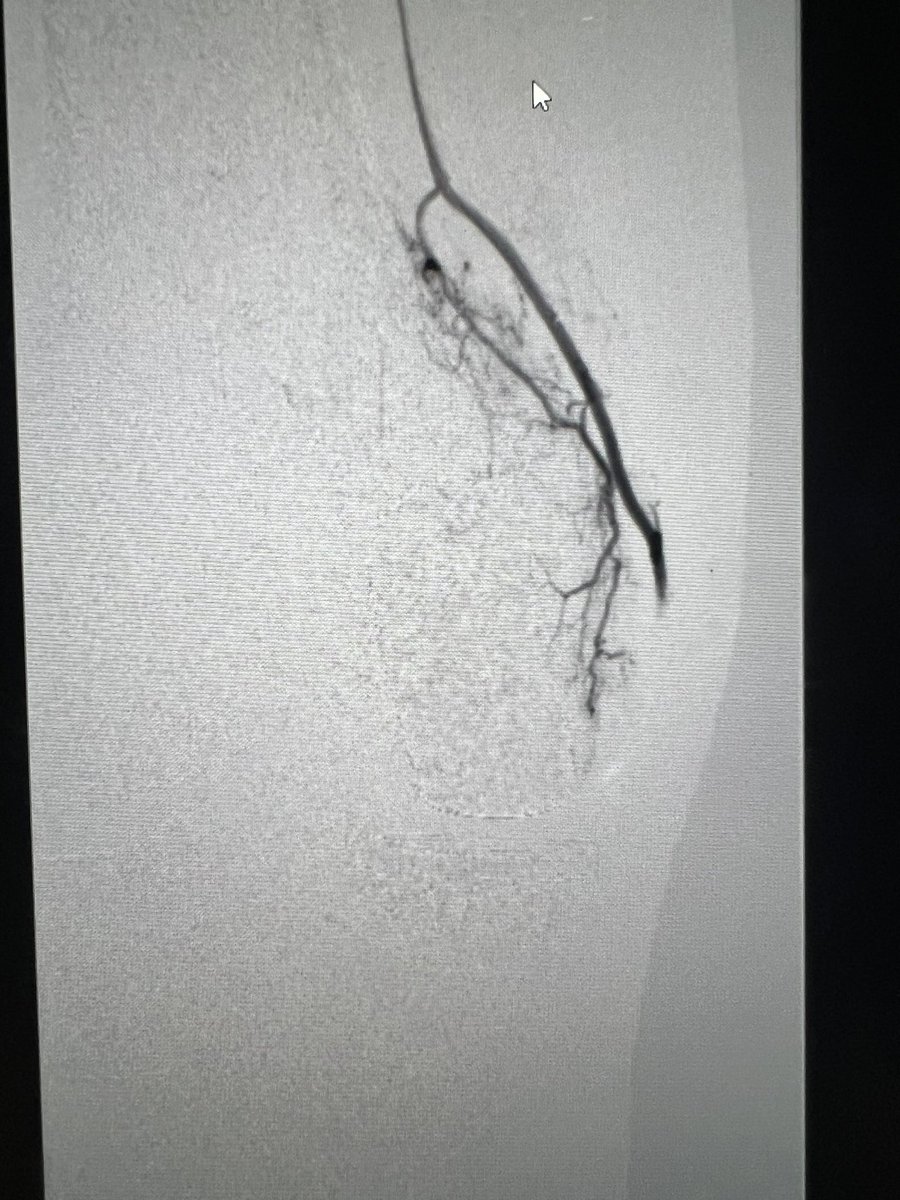 1 week post GAE after partial arthroplasty - “Doc, before you even say anything, what a difference this had made, feels like I’ve turned right around!” - Pt back to gardening and golf #WithoutAScalpel #GAE #orthotwitter #MSK #pain #VIRad