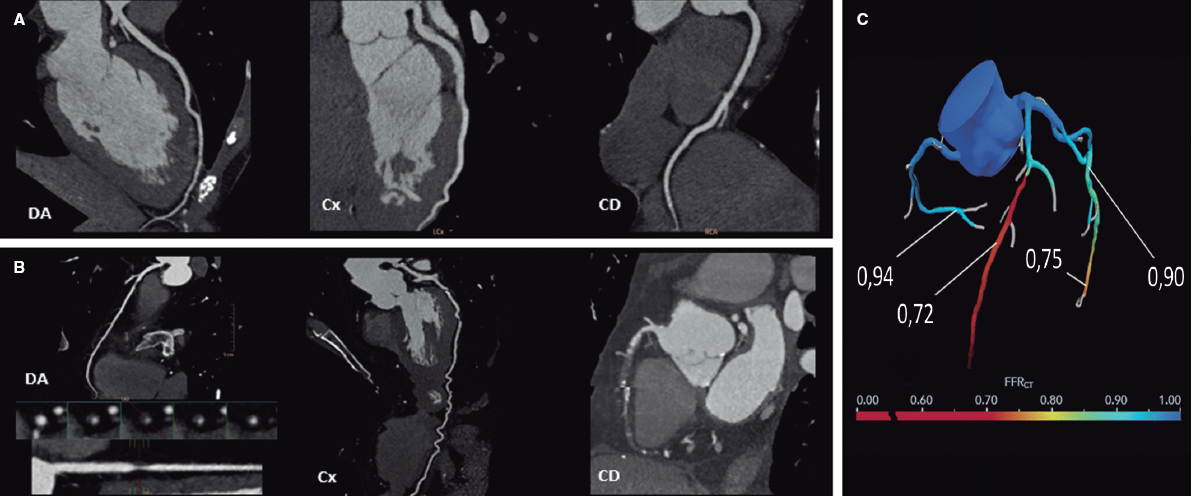 Papel de la tomografía computarizada en los procedimientos de cardiología intervencionista coronaria y estructural #recintervcardiol  <a href="/manuelbarreirop/">Manuel Barreiro-Perez</a> @chpedroli <a href="/che_parada/">Checho Parada</a> <a href="/lvaroRodriperez/">Álvaro Rodríguez Pérez</a>
<a href="/b_caneiro/">Berenice Caneiro</a> @Serlotes <a href="/pjantunez/">Pablo Antunez Muiños</a> <a href="/RodrigoEstvez1/">Rodrigo Estévez</a> <a href="/icruzgonzalez/">Ignacio Cruz Gonzalez</a> recintervcardiol.org/es/articulo-es…