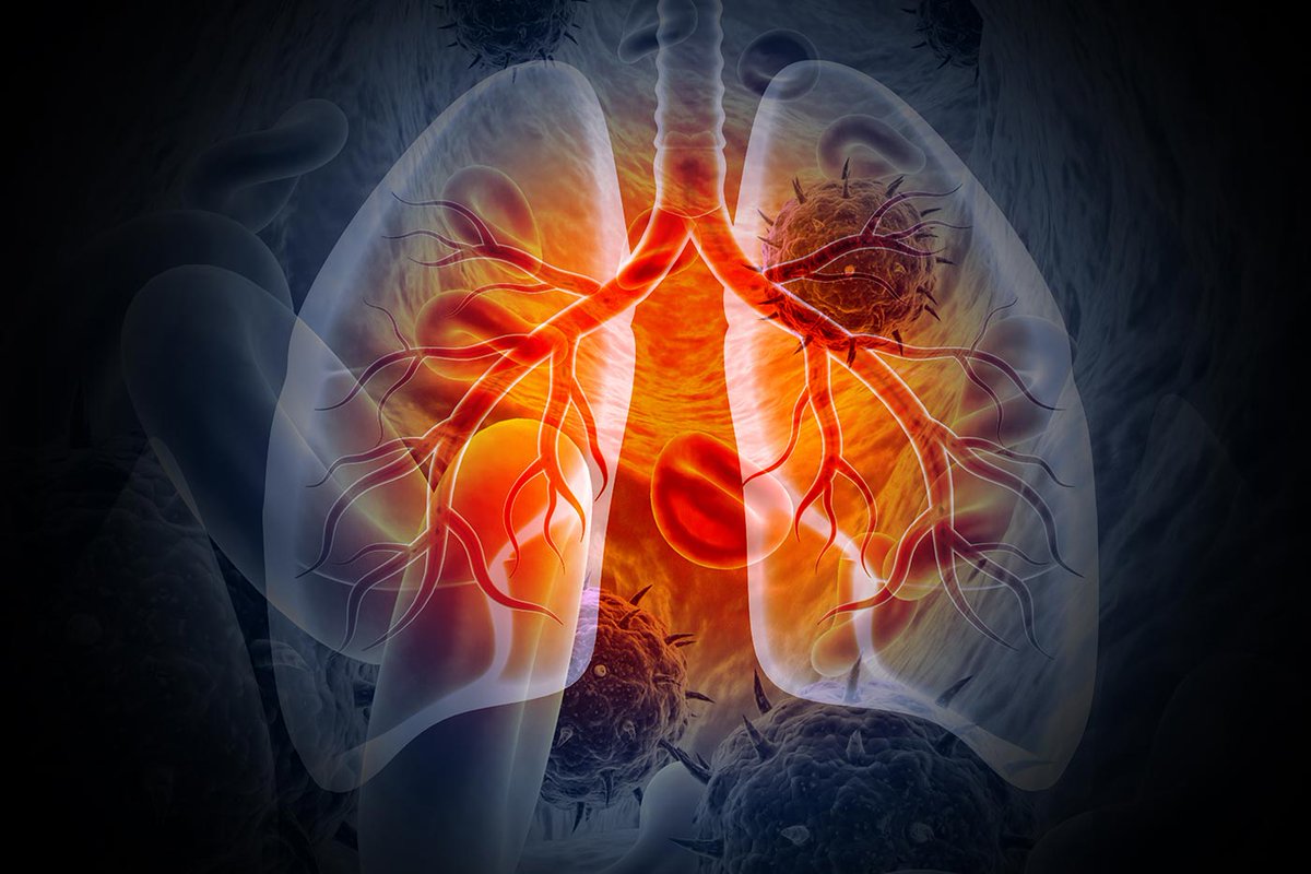 Immunotherapy before and after Surgery Improves Survival in Lung Cancer Patients

Results from the randomized CheckMate 77T trial showed that nivolumab significantly improved survival in operable NSCLC patients. Learn more: ow.ly/JaAf50RIsn2