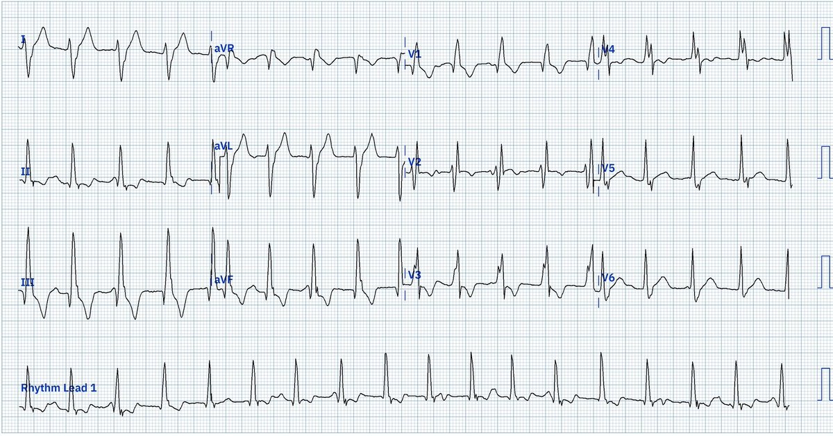 Male in his 40s with palpitations 

What do you think of the rhythm?

#ECG #EKG #Cardiology #Epeeps #FOAMed #CardioTwitter #Medtwitter #PMcardio #Emergencymedicine #MedEd #MedicalEducation