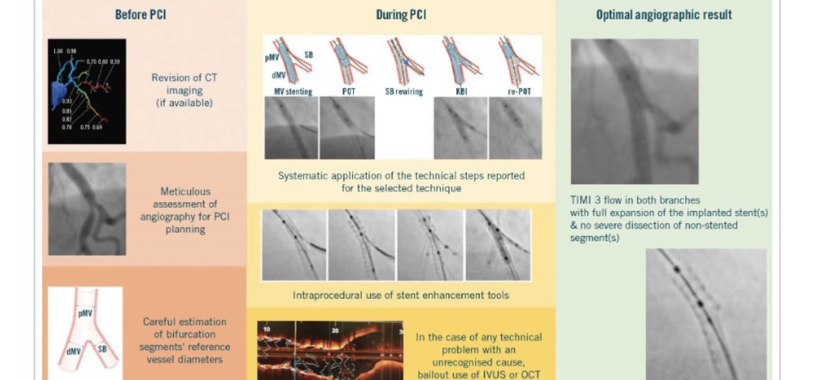 #IVUS and #OCT are simply great to guide bIfurcation and LM #PCI . They also increased our knowledge in the field. In the absence of them, operators should be committed to offering a similar PCI efficacy. This last #EBC consensus docunent provides very practical insights!