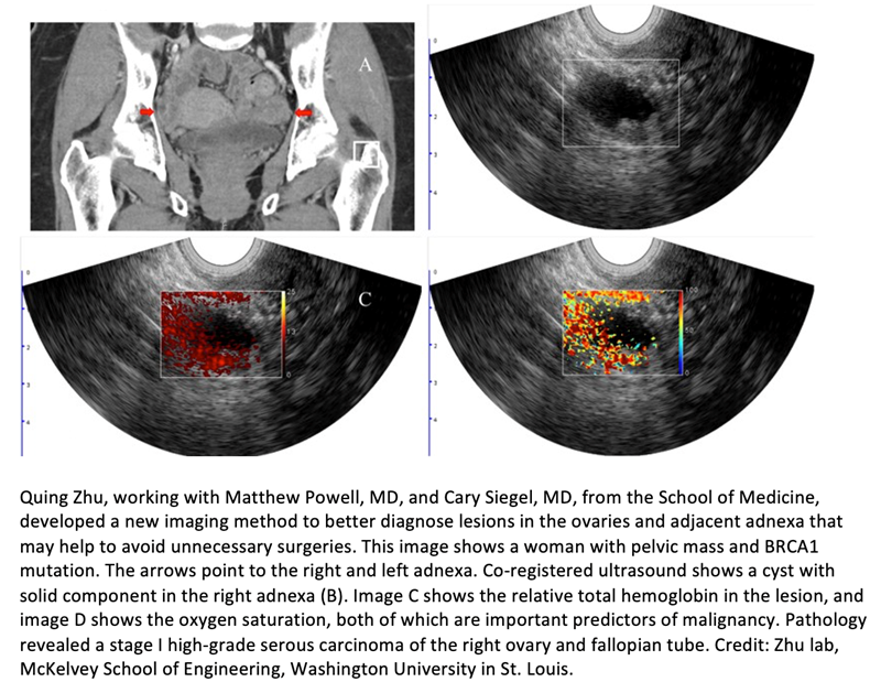 Photoacoustic Imaging Improves Diagnostic Accuracy of Ultrasound in Ovarian Cancer Learn more ➡️ bit.ly/3ynTZqT #RadOnc #NWHW #OvarianCancer #Imaging #Ultrasound