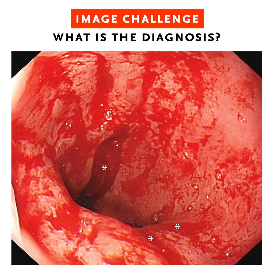 A 79-year-old woman presented to the emergency department with a 3-day history of hematemesis, melena, and epigastric pain. Approximately 1 day before the onset of symptoms, nonbloody vomiting had developed after she had eaten unrefrigerated food. 1/5